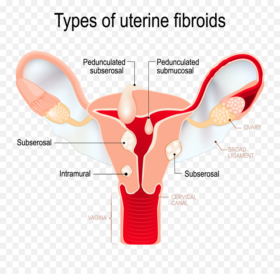 Uterine Fibroids And Polyps - Types Of Fibroids Png,Uterus Png