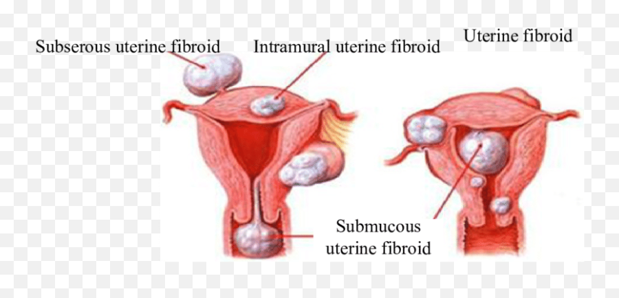 Patients Uterine Fibroids Table - Course Of Fibroids Png,Uterus Png