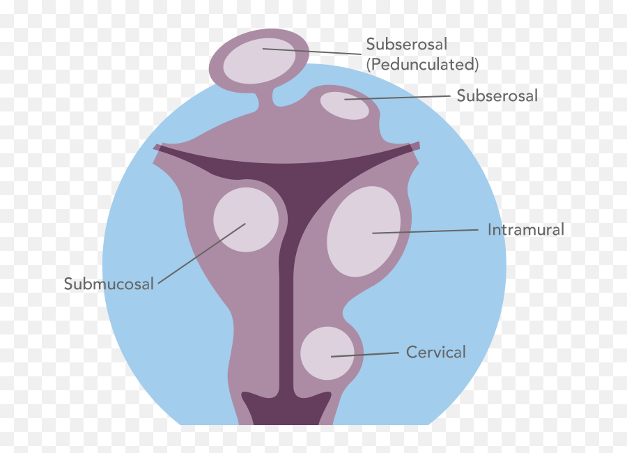 Uterine Fibroid Articles - Illustration Png,Uterus Png