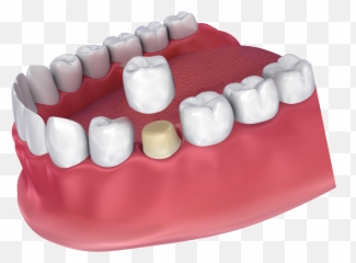 Dental Crowns Foods And Drinks To Avoid - Jackson Ms Dental Crown Png,Crowns Png