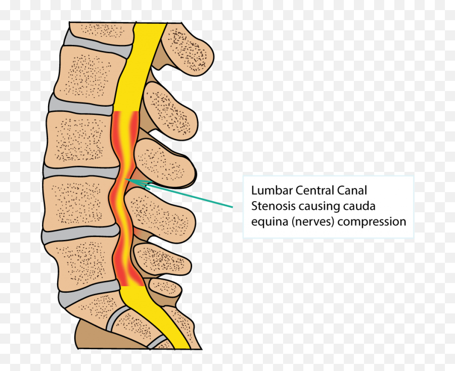Spinal Stenosis Dr Yu Chao Lee - Diagram Png,Spine Png