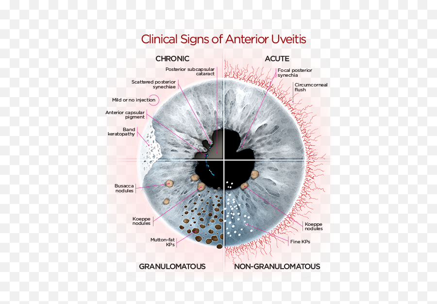 Anterioruveitisdiagrampng 500558 Uveitis Eye Facts - Clinical Signs Of Uveitis,Human Eyes Png