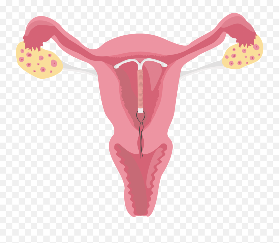 Uterus - Female Reproductive System With Iud Png,Uterus Png
