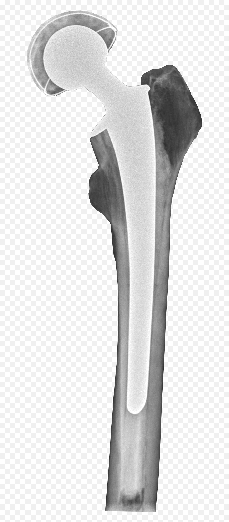 Filepostoperative Radiograph Of Hip Prosthesis - Splitting Maul Png,Axe Transparent