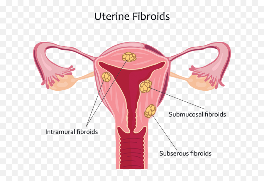 Uterine Fibroids - Uterine Fibroid Png,Uterus Png