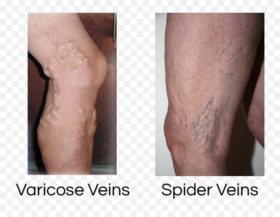 Vein Disorders Specialists Of - Spider Veins Png,Veins Png