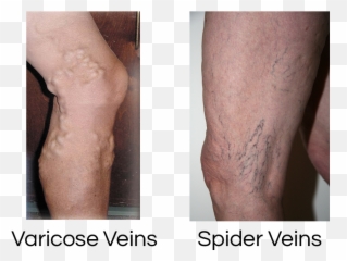 Vein Disorders Specialists Of - Spider Veins Png,Veins Png