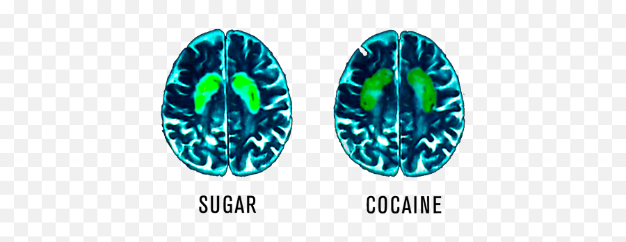 Sweet Tooth Foggy Brain U2014 Russell Boon - Sugar Affects Your Brain Png,Cocain Png