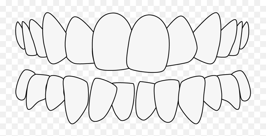 Teeth Crowding Causes U0026 Treatment Drsmile - Malocclusion Png,Vampire Teeth Icon