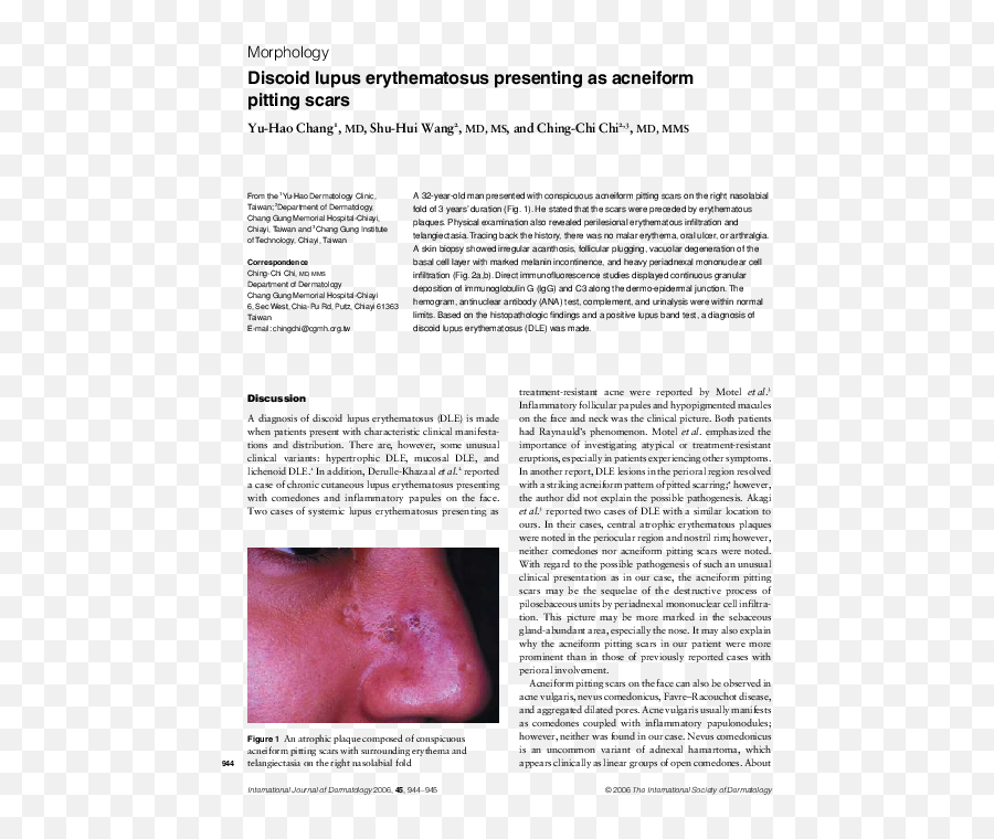 Pdf Discoid Lupus Erythematosus Presenting As Acneiform - Discoid Lupus Erythematosus Pdf Png,Lupus Icon