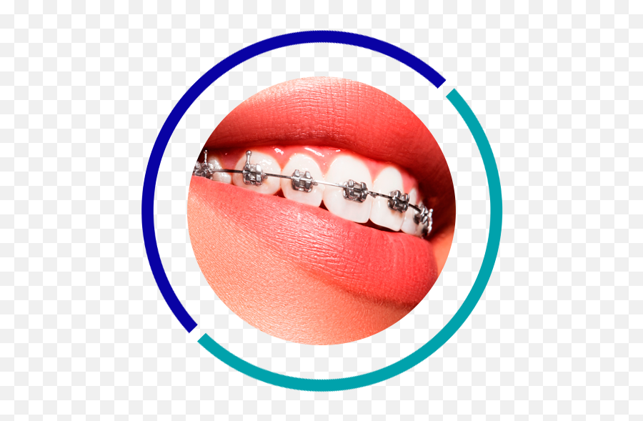 Download Orthodontics - Teeth Braces In Qatar Price Png,Braces Png