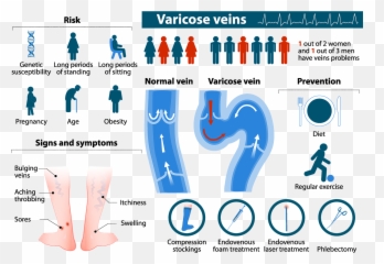 Varicose Veins Dickson Medical Associates - Varicose Vein Treatment Options Png,Veins Png