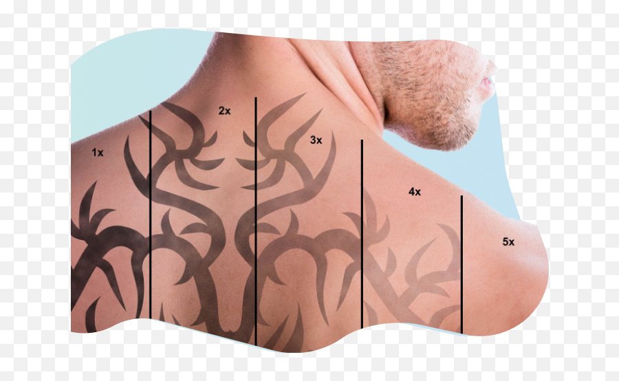 Laser Tattoo Removal In Dubai Eyebrow - Laser Tattoo Removal Body Png,Chest Tattoo Png