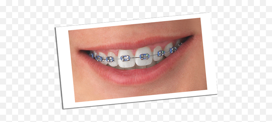 Braces U0026 Orthodontics Faribault Owatonna Rochester Mn - Happens When You Don T Brush Your Teeth With Braces Png,Braces Png