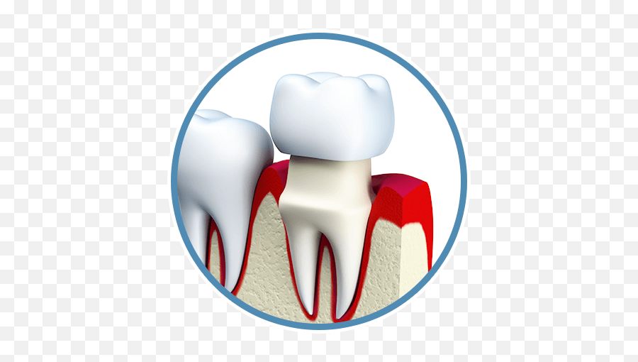 Download Hd Dental Crowns - Tooth Porcelain Figure Png Tooth Crown Fell Out,Crowns Png