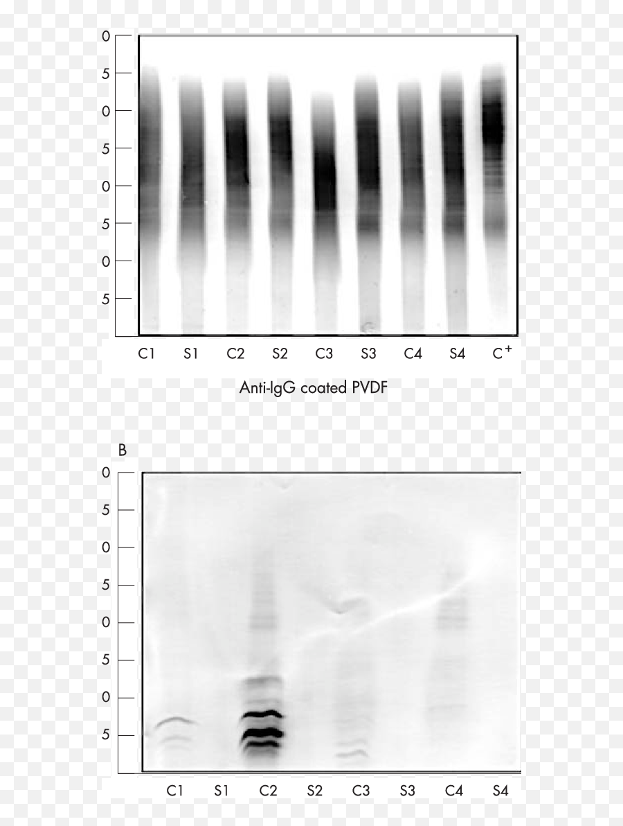 Immunoblots Of Igg A And Free Kappa Bands B From Four - Monochrome Png,Kappa Png