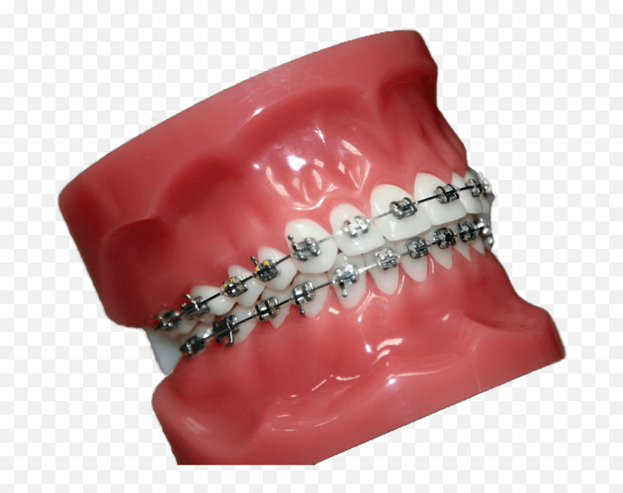 Buccal Braces Walsall Orthodontist Allsopp Orthodontics - Ring Png,Braces Png