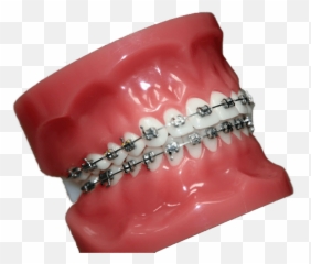 Buccal Braces Walsall Orthodontist Allsopp Orthodontics - Ring Png,Braces Png