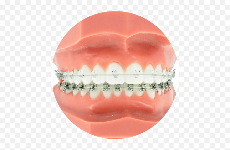 Clear Braces Full Size Png Download Seekpng - Clear Braces,Braces Png