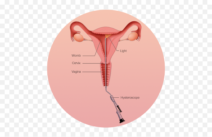 Uterine Fibroids Diagnosis - Fibroidsconnectcom Uterine Fibroid Png,Uterus Png