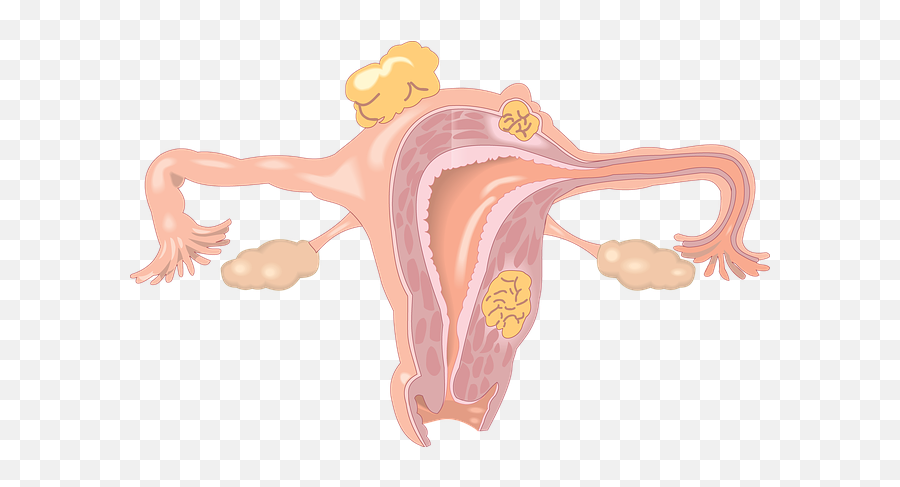 Endometriosis And Fibroids With Connection To Co - Dependancy Baby In The Uterus Png,Uterus Png