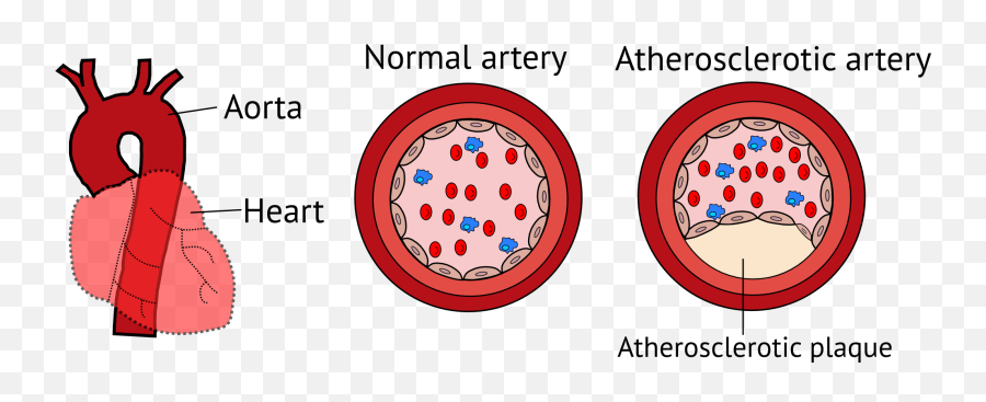 Dental Plaque Itinerary Blood Vessels Unraveling The - Circle Png,Blood Cut Png