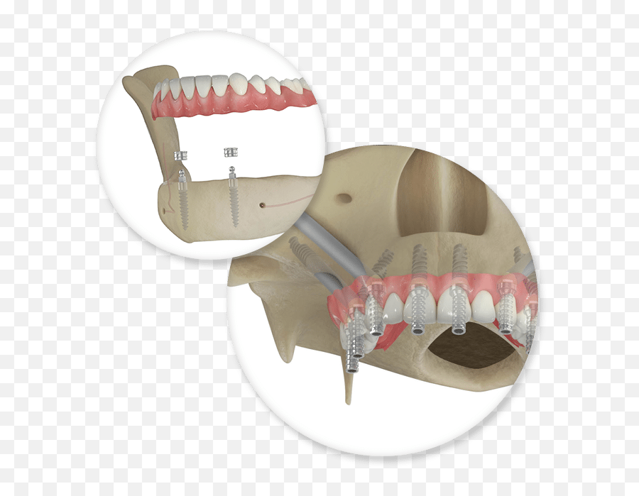 Dental Implants Implant Specialist Las Vegas - Bone Png,Jawbone Icon Earpiece Replacement