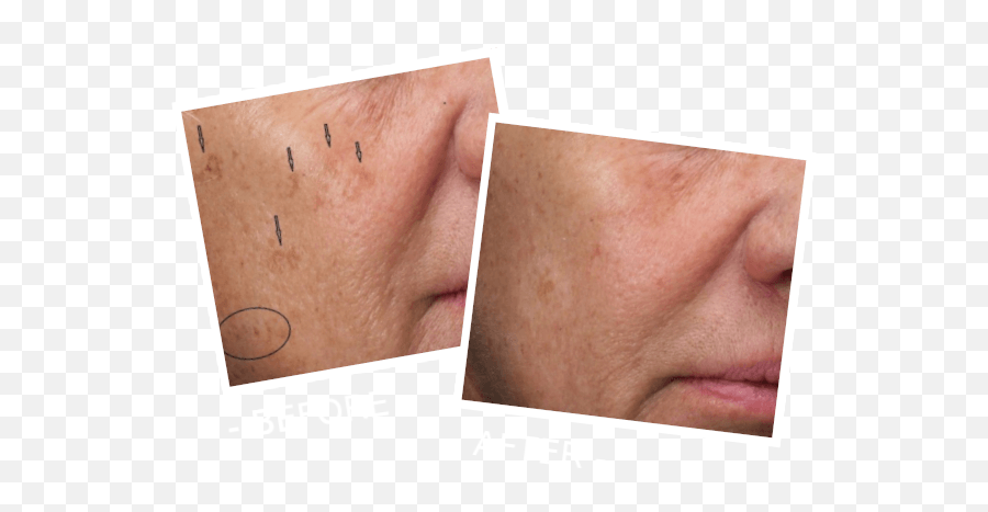 Most Advanced Iot Based Skin Rejuvenation Machine Jóli360 - Disease Png,Icon Laser Before And After