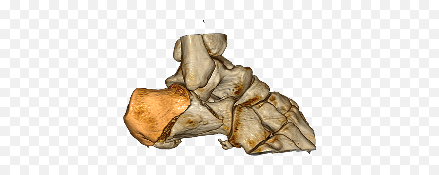 Tongue - Type Fractures Minimal Invasive Treatment Of Dry Png,Invasive Icon