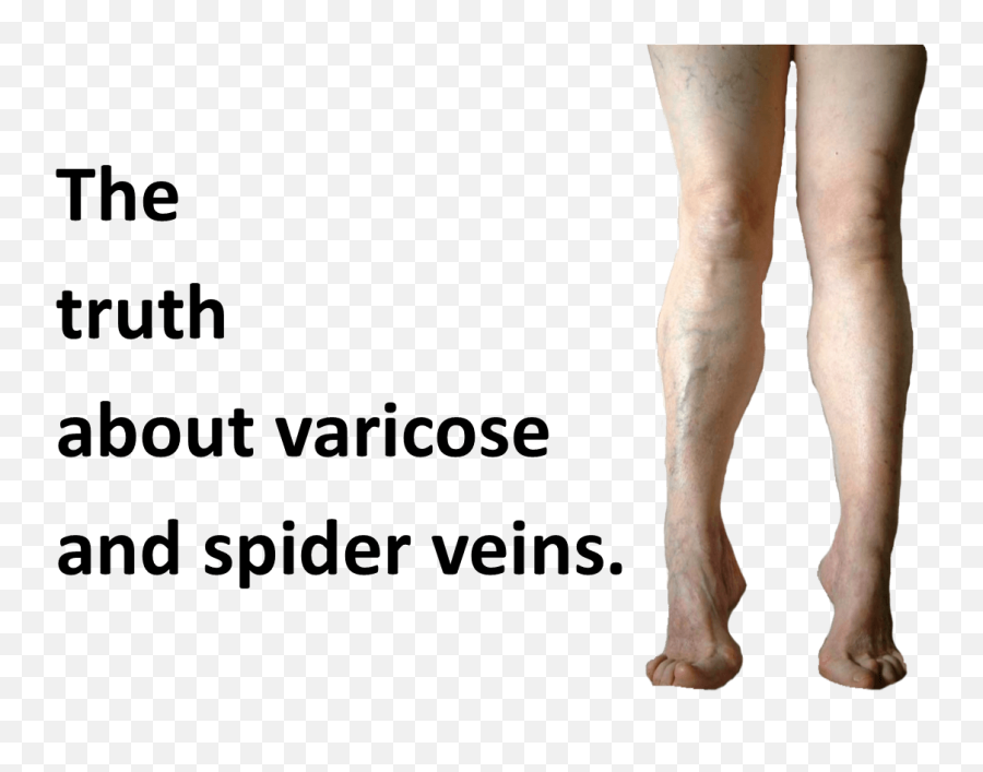 Youu0027re So Vein The Truth About Varicose And Spider Veins - For Women Png,Veins Png