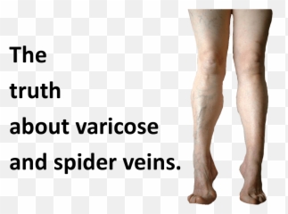 Youu0027re So Vein The Truth About Varicose And Spider Veins - For Women Png,Veins Png