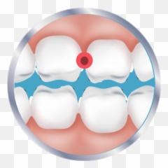 Is It A Cavity Or Sensitive Teeth - Bracket Png,Aniami Teeth Icon