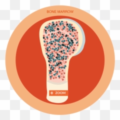 What Is Chronic Lymphocytic Leukemia Cll Or Small - Light Bulb png