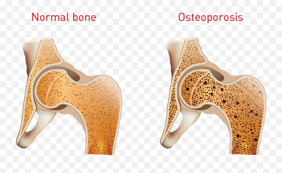 Factsheet - Coffee And Health Femoral Neck Bone Density Png,Bone Transparent Background