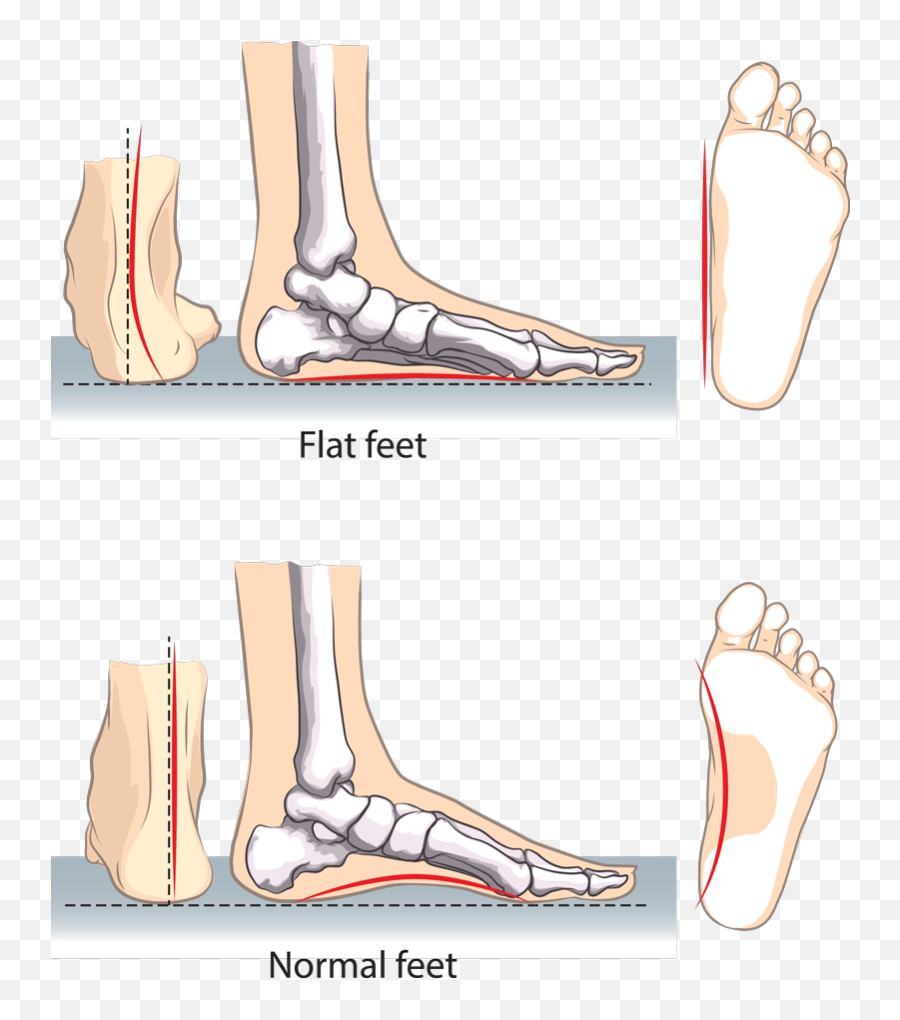 How To Ease Pain Caused By Flat Feet And Arthritis Foot - Work Shoes For Flat Feet Png,Feet Png