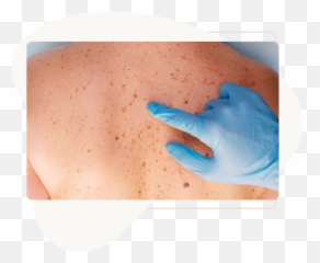 Manchas - Clínica Kede U0026 Sabatovich Medical Glove Png,Manchas Png