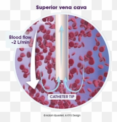 Treating Occluded Catheters - Cathflo Activase alteplase Vertical png