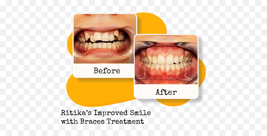 Braces Treatment In Mukherjee Nagar Model Town Civil - Best Dentist In Guwahati Png,Braces Png