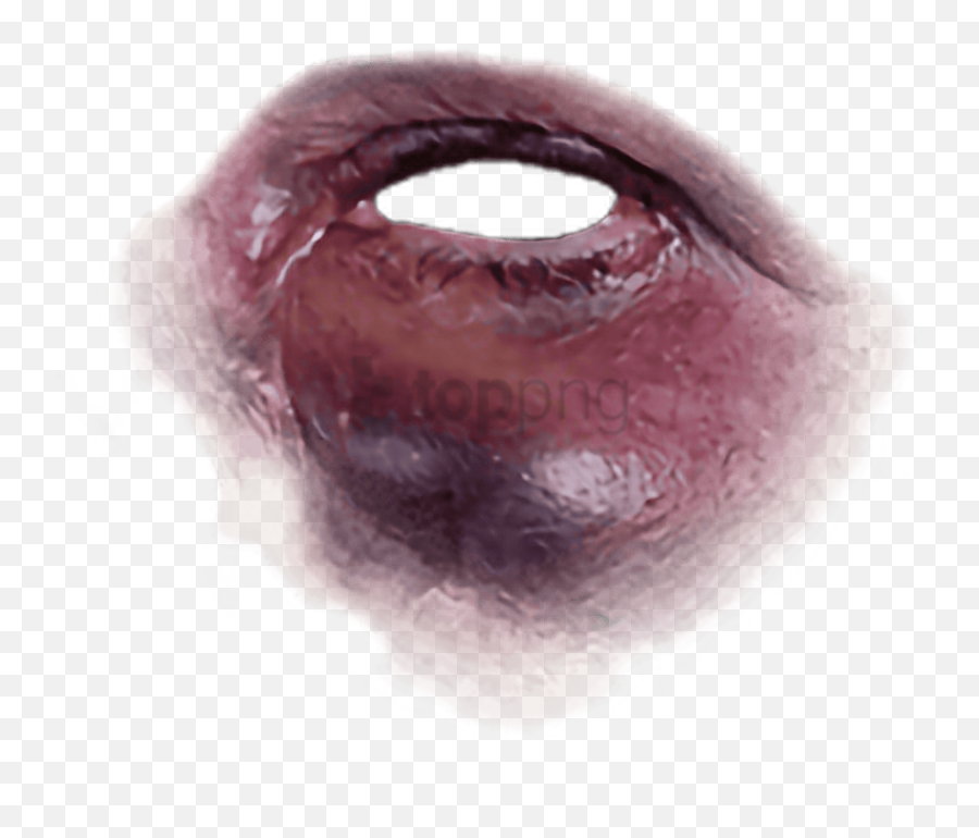 Black Eye Bruise Png Image - Bruise Black Eye Png,Black Eye Png