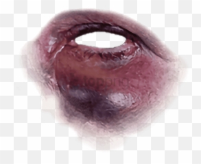 Black Eye Bruise Png Image