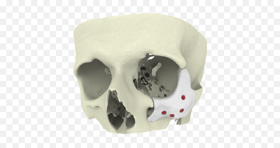 Royal Academy Of Engineering Recognises 3d Printed Bone As - 3d Printed Facial Implant Png,3d Skull Png