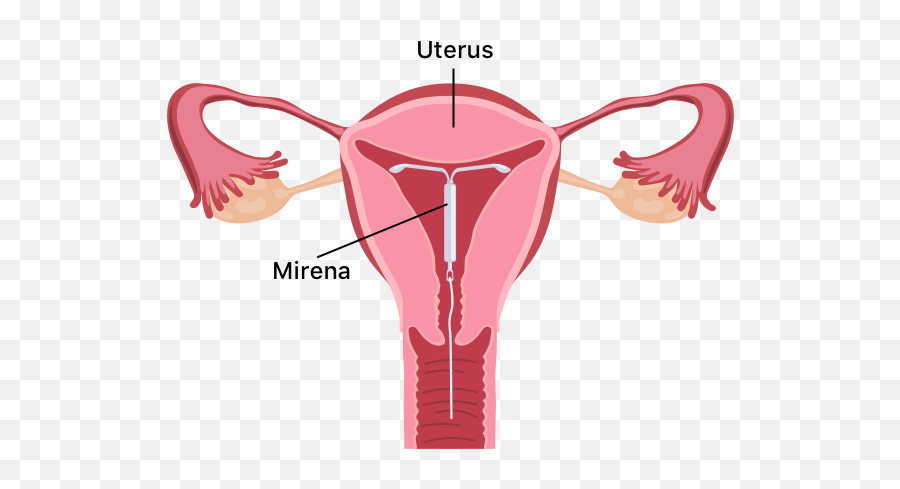 Mirena How It Works Pros U0026 Cons Interactions And Cost - Fibroids On Uterus Png,Uterus Png