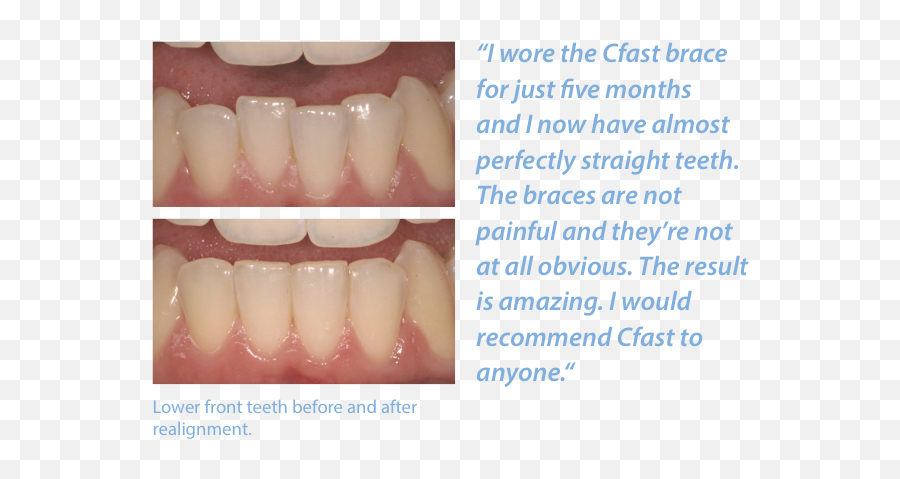 Are Cfast Braces The Fastest Way To Straighten Teeth - Cosmetic Dentistry Png,Braces Png