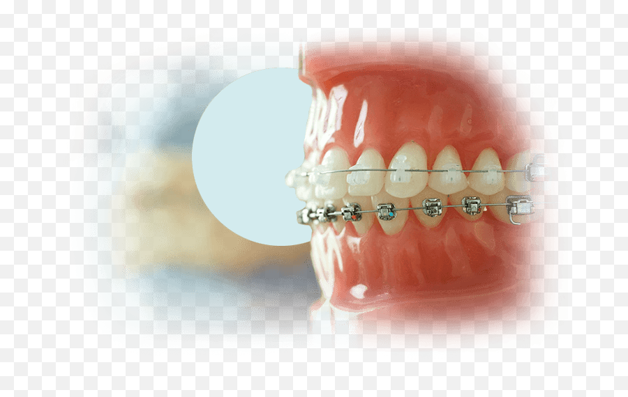 Types Of Braces Orthodontist In Darwin Orthodontics - Tongue Png,Braces Png