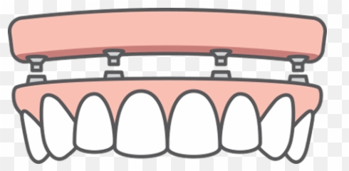 Dental Implants - Grille png