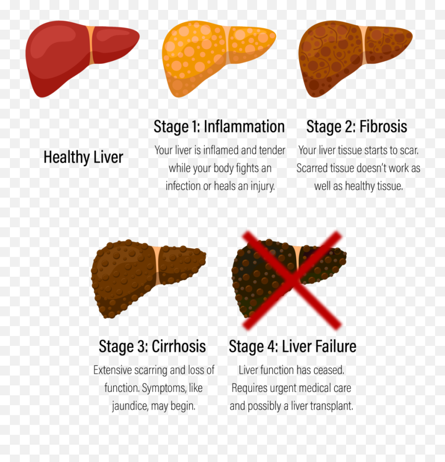 Diagnosing Liver Fibrosis Choosing The Right Test For You - Fibrosis Liver Png,Interstim Icon