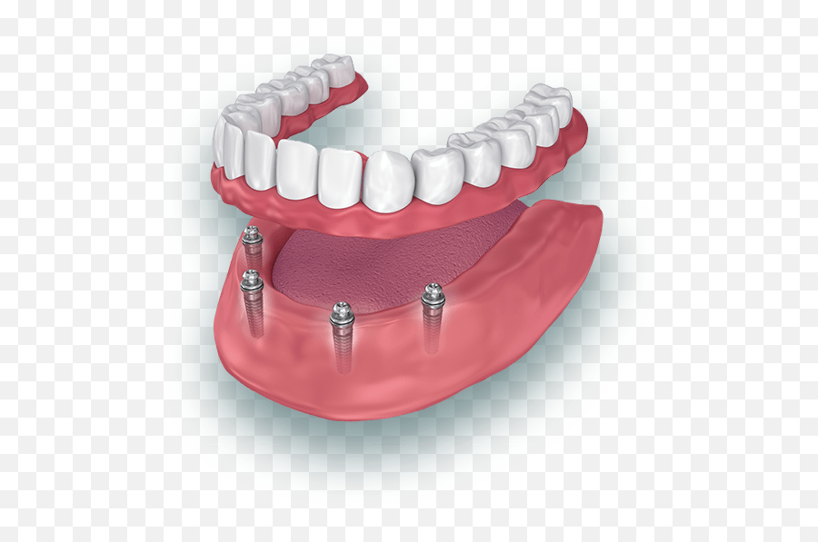 All - Lower Denture Implants Png,Jawbone Icon Replacement Parts