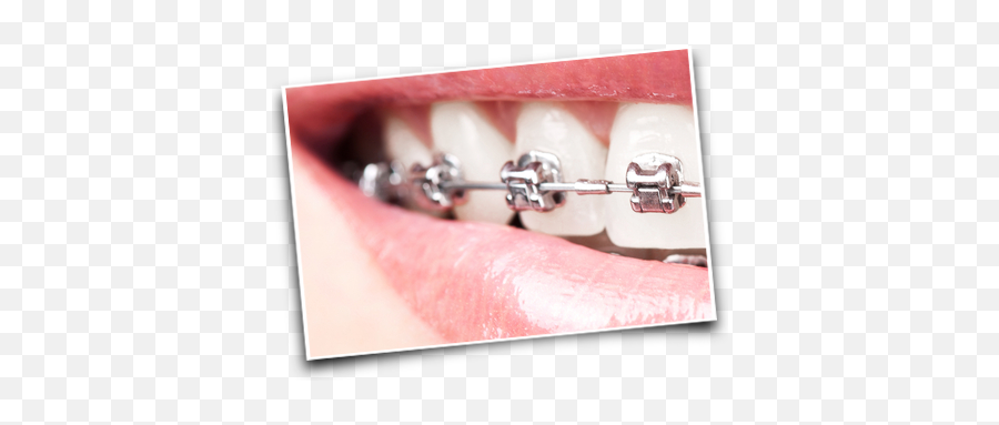 Orthodontics Eastgate Dental Surgery - Conventional Metal Braces Png,Braces Png