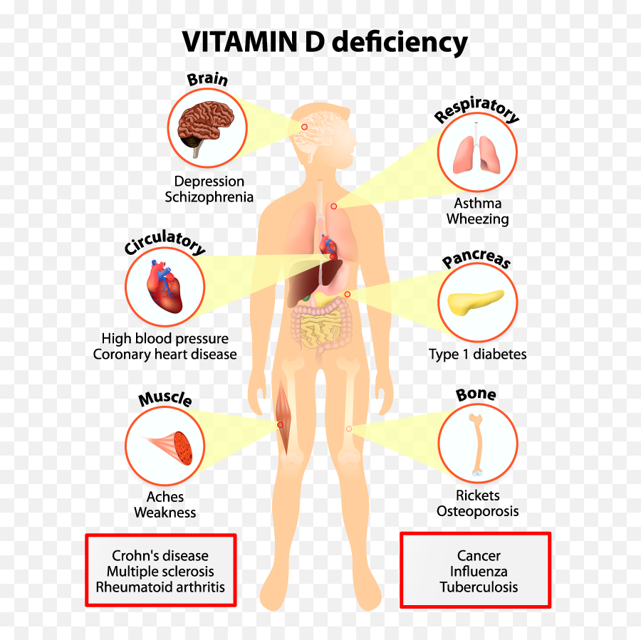 Important Signs - Disease Caused By Vitamin D Deficiency Png,D&d Png