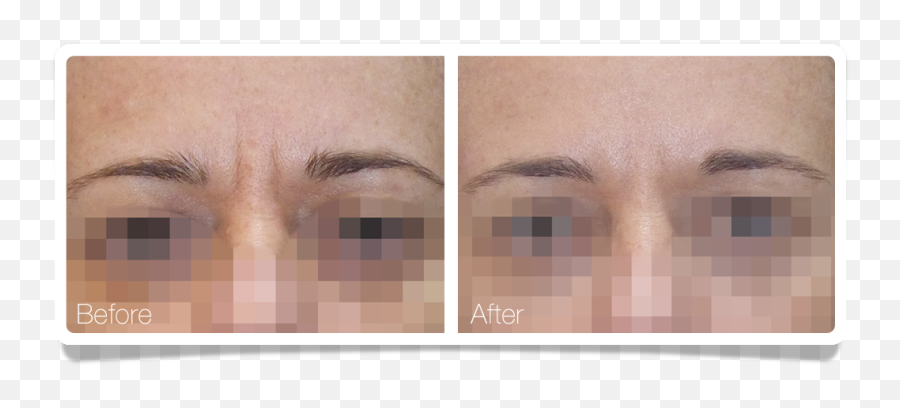 Clínica Áureo - Wrinkles Between The Eyebrows Eye Shadow Png,Angry Eyebrows Png